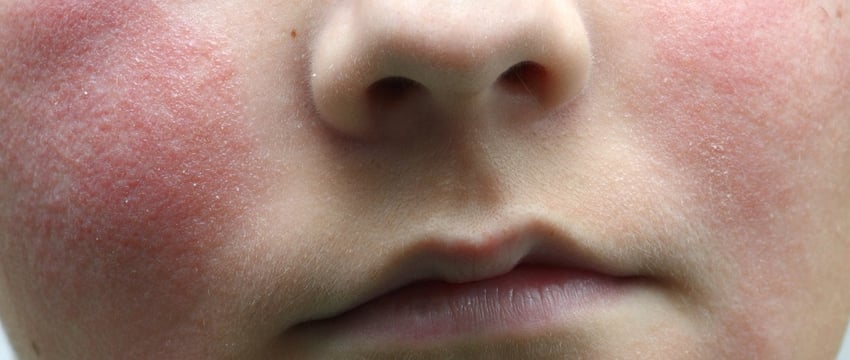 В США растет число случаев заражения парвовирусом человека В19, CDC предупреждает о вирусе "пощечины"