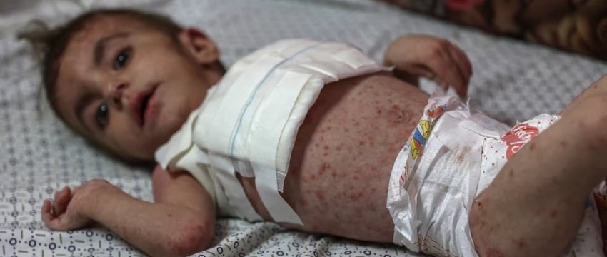 Опасные кожные заболевания распространяются среди недоедающих детей в Газе.