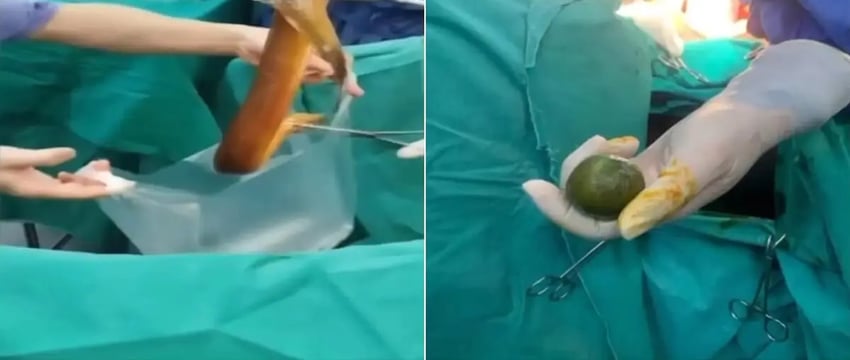 Индеец во Вьетнаме засовывает угря себе в задний проход, и тот разъедает его внутренности.