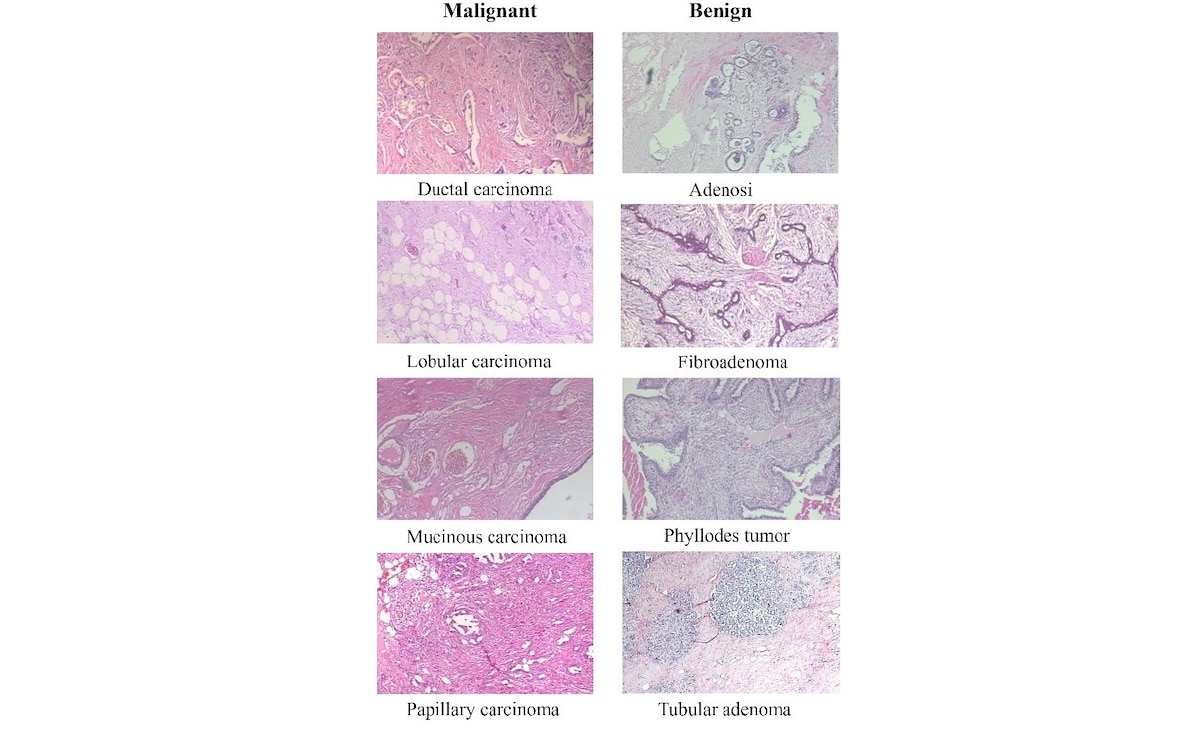 Representative microscopy images of malignant and benign breast tissues from the BreakHis dataset (Image Source: Cancers 2024, 16(12), 2222)
