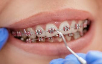 Зубы ровные, но с последствиями: истории белорусок о том, как они брекеты носили