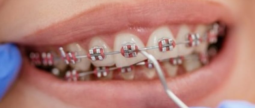 Зубы ровные, но с последствиями: истории белорусок о том, как они брекеты носили