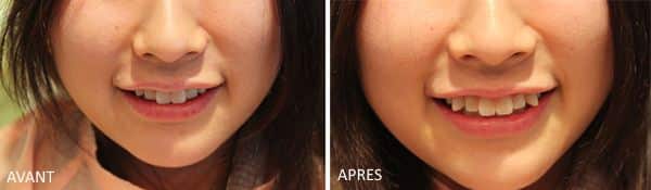 Cette japonaise s'est fait faire des dents de vampire ou "Yaeba"