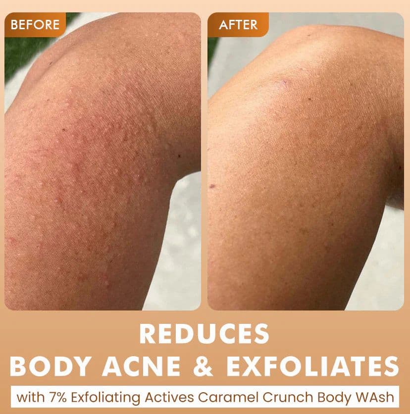 Brighten, De-Tan & Acne-Free Body Wash Combo