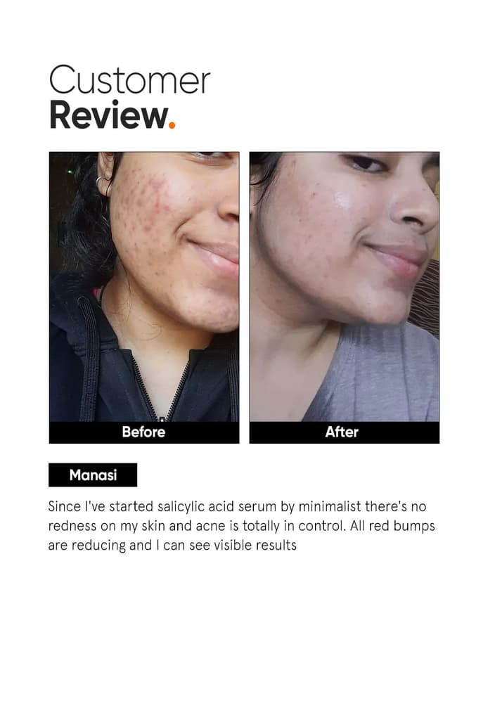 Salicylic Acid 2% Face Serum — photo 5