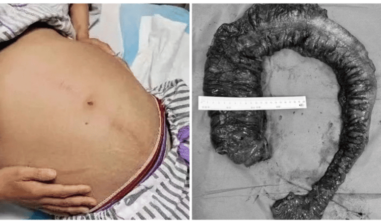 Médicos retiram fezes gigante do intestino de uma mulher na China