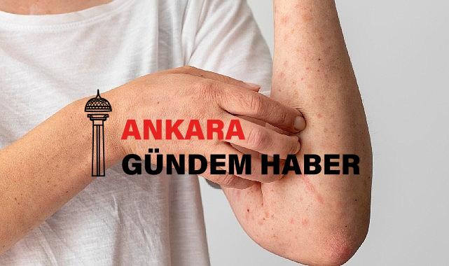 1 Ekim Dünya Ürtiker Günü: Gereksiz Besin Diyetleri Ürtikeri Tetikliyor
