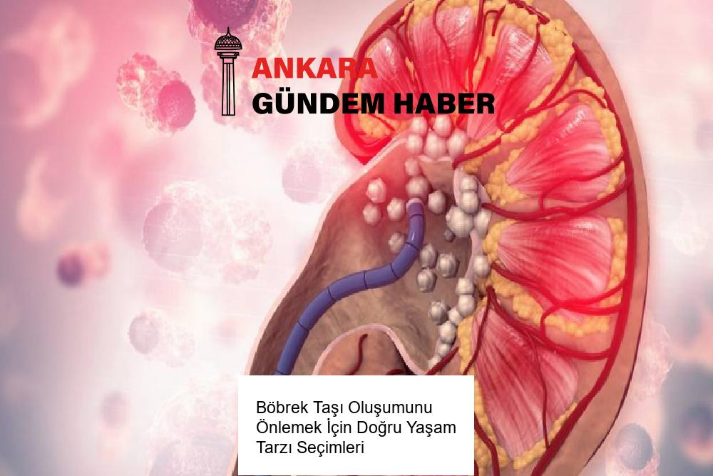 Böbrek Taşı Oluşumunu Önlemek İçin Doğru Yaşam Tarzı Seçimleri