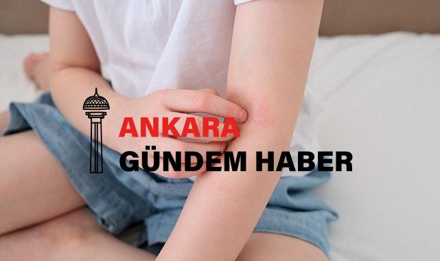 Çocuklarda ‘Alerjik Hastalıklar’ Hakkında Doğru Sanılan 8 Hatalı Bilgi!