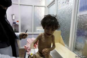 聯合國警告葉門   小心孩童活活餓死