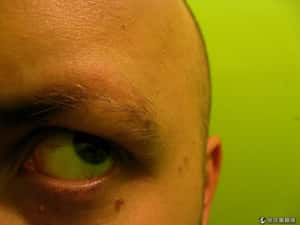 鬼剃頭落髮有救!  美學者用脊髓藥物喚回新髮