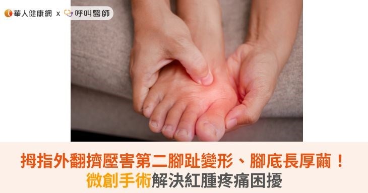 拇指外翻擠壓害第二腳趾變形、腳底長厚繭！微創手術解決紅腫疼痛困擾