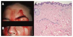 流血汗：義大利女子的罕見怪病