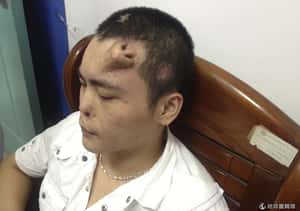 車禍受傷 中國男人額頭種鼻治療