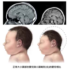 美國：茲卡病確實是小頭症兇手   茲卡病毒懶人包(更新至4/14)