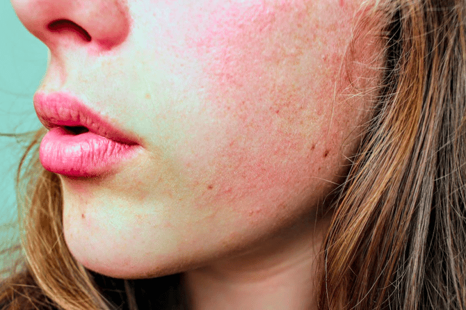 Managing Eczema Symptoms & Treatment