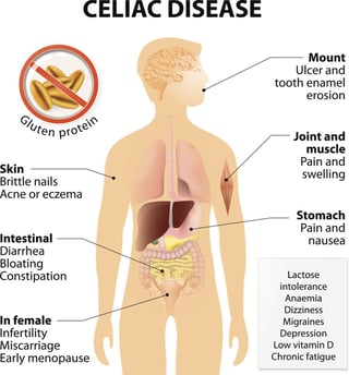 Symptoms of Celiac disease