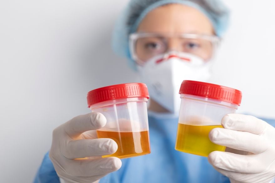 Ketones in Urine