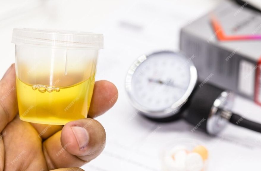 Ketone Impact on Urine