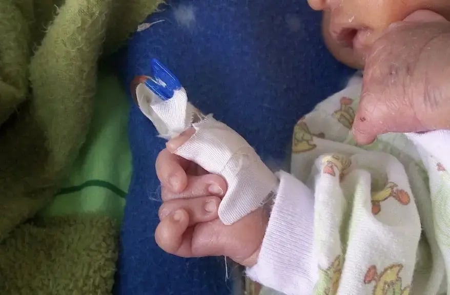 Child having Edward syndrome