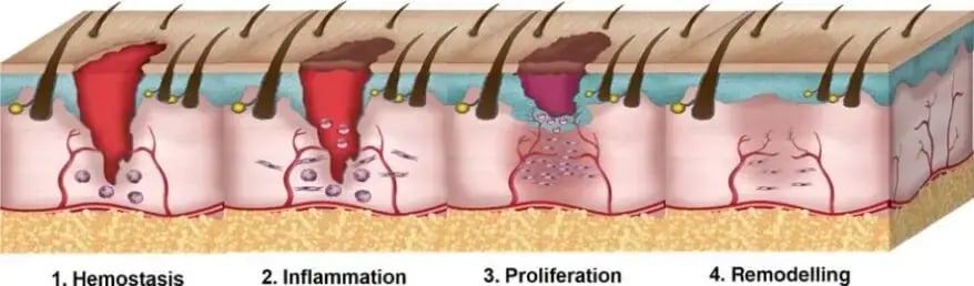 four stages of wound healing process