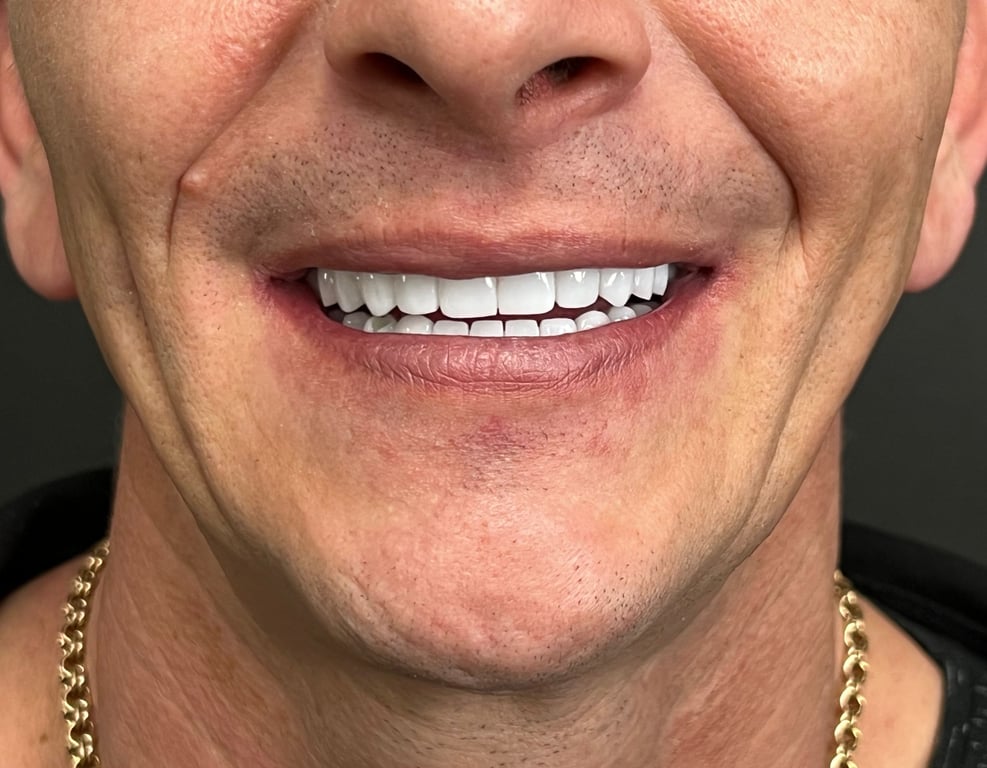 All on 4 dental implants in Da Nang by bon