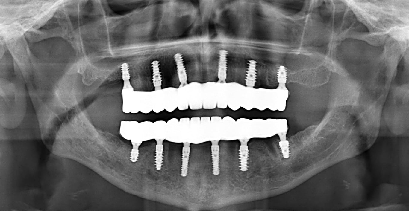 All on 6 dental implants in Da Nang by bon