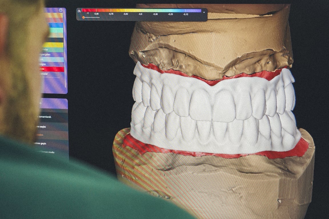 طب الأسنان CAD-CAM: تقنية حديثة لاستعادة الأسنان المفقودة