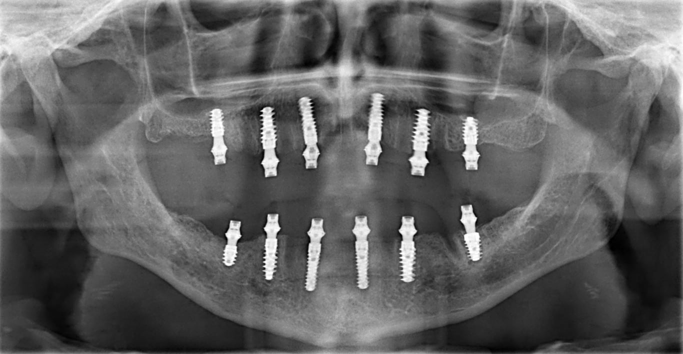 All on 6 dental implants in Da Nang by hai