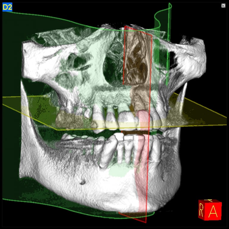 All on 4 dental implants in Da Nang by mot