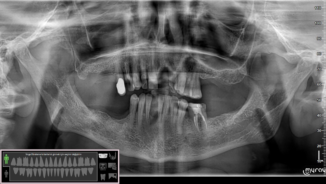 All on 6 dental implants in Da Nang by mot