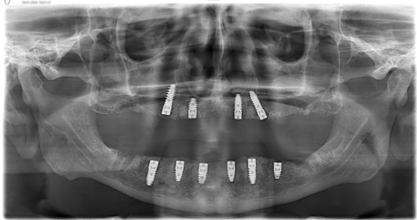 All on 4 dental implants in Da Nang by hai