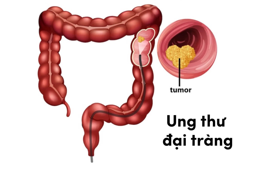 Ung thư đại tràng