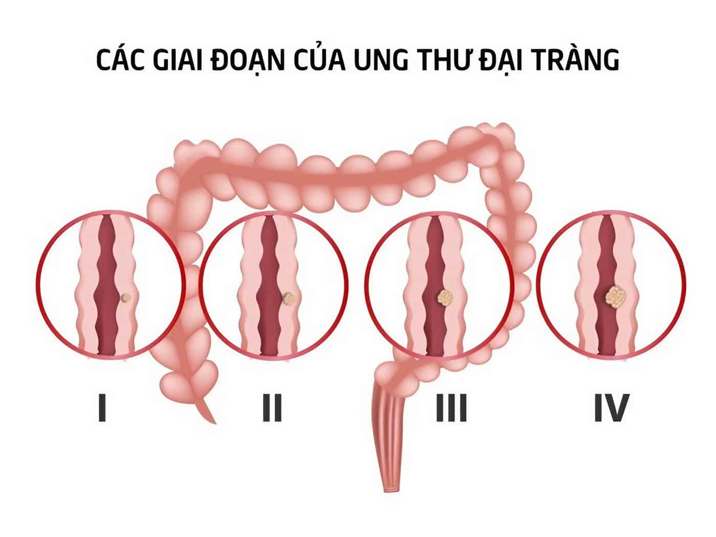 Ung thư đại tràng