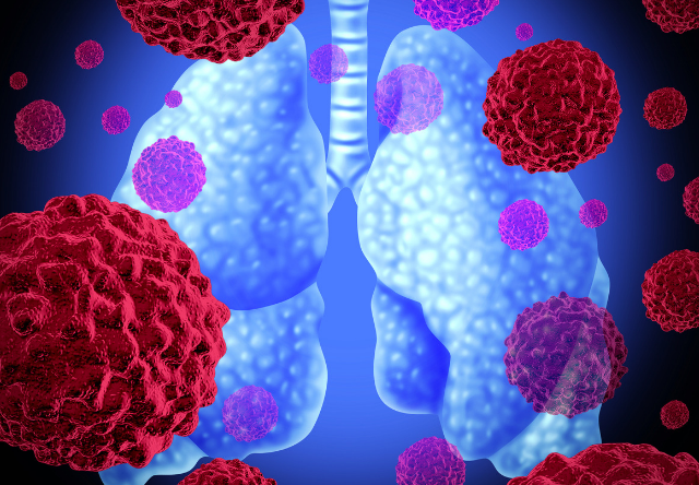 Impower133 Trial Demonstrates Immunotherapy in Small Cell Lung Cancer