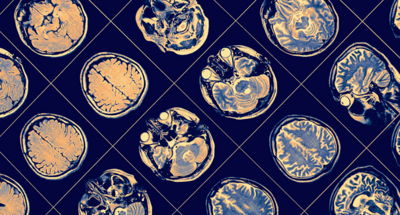 AbbVie s Subcutaneous Parkinson s Disease Drug ABBV 951 Reaches 