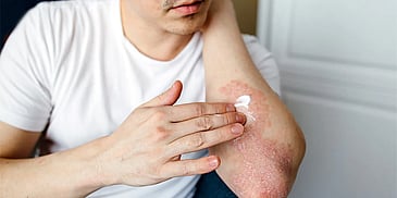 The Modern Guide to Psoriasis Treatment in Dubai