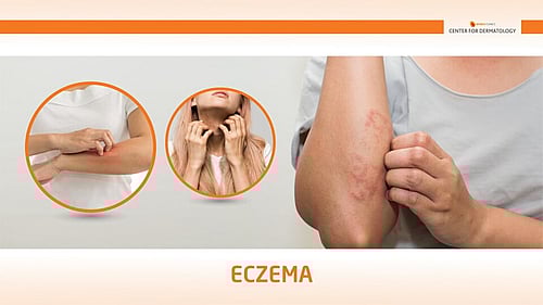 ECZEMA