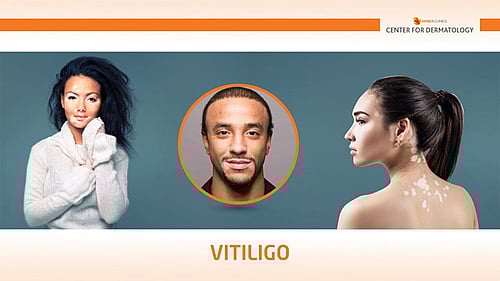 VITILIGO