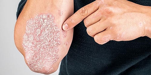 Get the effective treatment for psoriasis from a highly experienced dermatologist