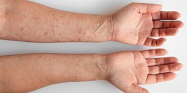 Living Better with Psoriasis: Simple Help in the UAE