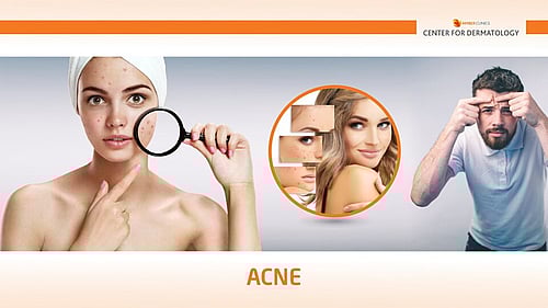 ACNE
