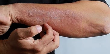 The Right Way to Heal: Essential Mandates for Psoriasis Treatment at Amber Clinics