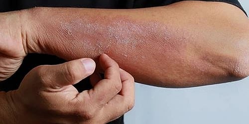 The Right Way to Heal: Essential Mandates for Psoriasis Treatment at Amber Clinics