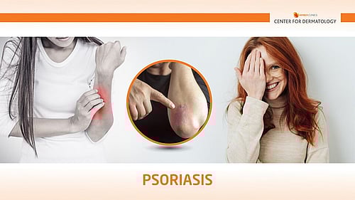 PSORIASIS