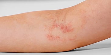 Managing chronic psoriasis with specialized treatment for healthier and clearer skin