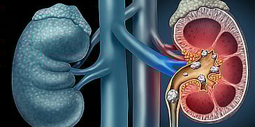 How Kidney Stones & Prostate Issues Really Affect Life