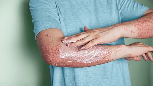 Understanding Psoriasis: Early Signs You Should Not Ignore