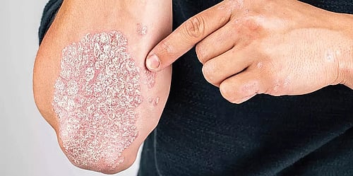 Simple Psoriasis Care and Skin Health in Dubai