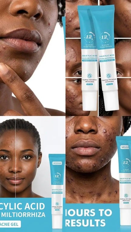 Gel Anti acne de Ácido Salicílico 